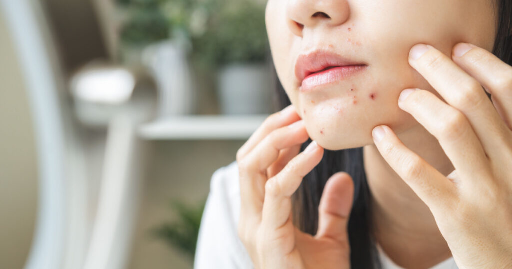 Expression worry asian young woman looking at mirror touching pustule around the chin and mouth, allergic when wear mask, spot scar from pimple on face. Beauty care, skin problem by acne treatment.