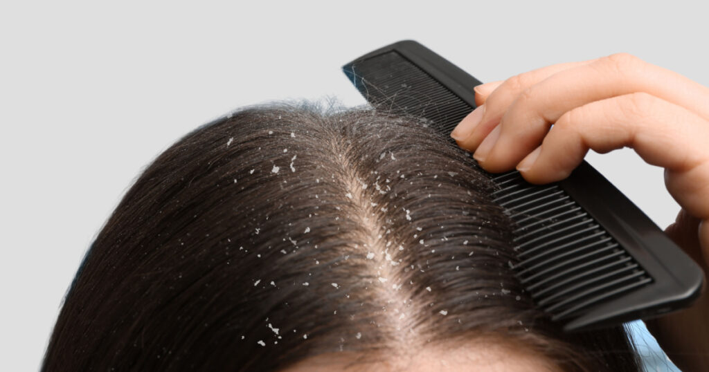 Dandruff problem. A girl with itchy head. Dandruff on the hair. Hair disease seborrhea. Fatty Dandruff.