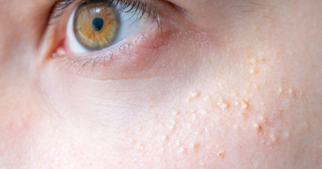 Milia (Milium) - pimples around eye on skin.