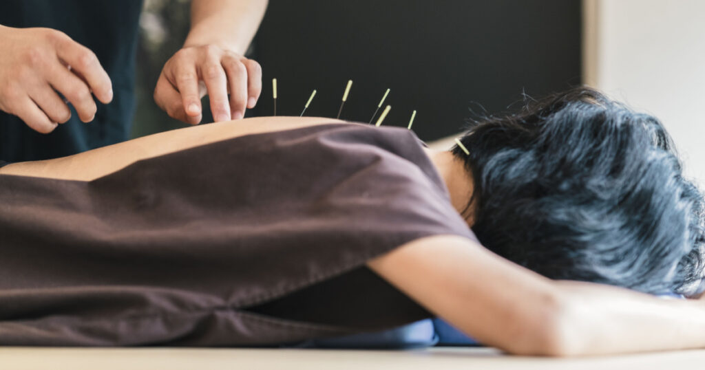 Therapist Giving acupuncture Treatment To a Japanese Woman