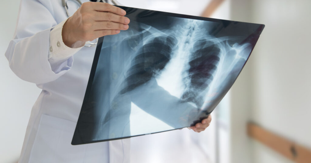 doctor checking chest x-ray film at ward hospital.