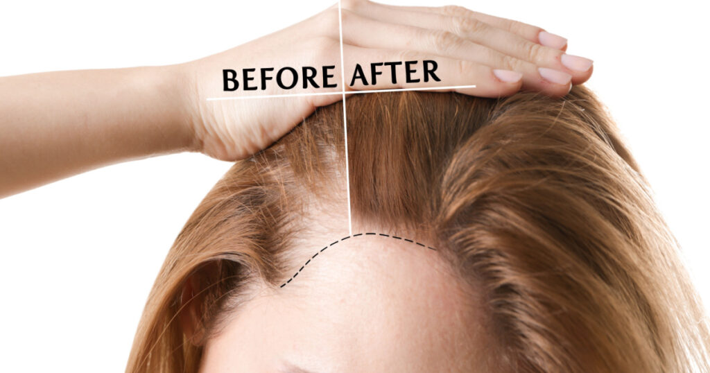 Woman before and after hair loss treatment on white background