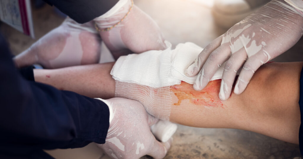 First Aid training. Leg injury. Training Concept