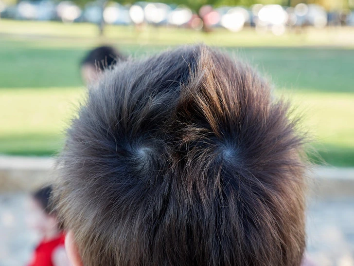 body traits - Counterclockwise Cowlicks