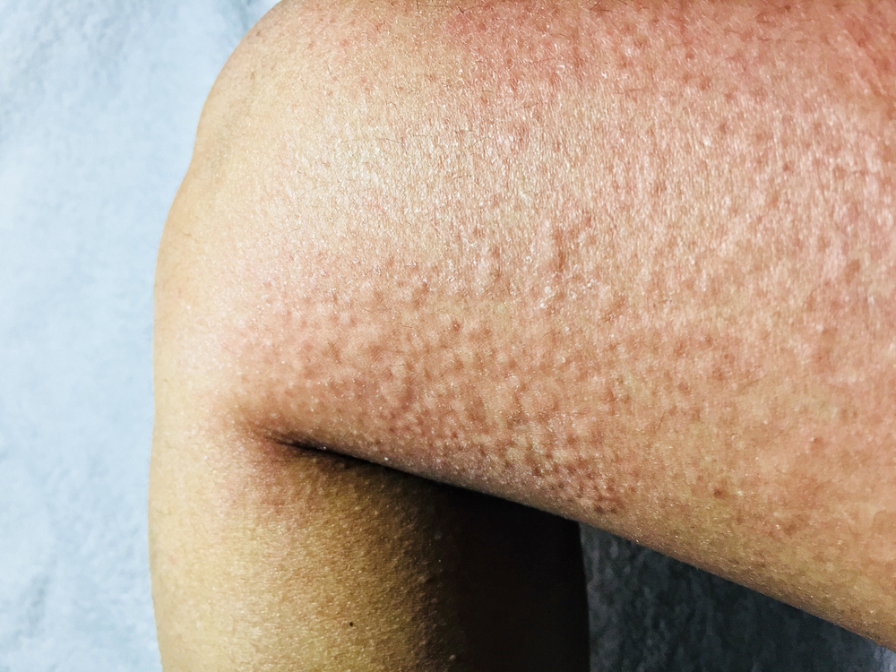 Cold Urticaria allergic on legs in winter