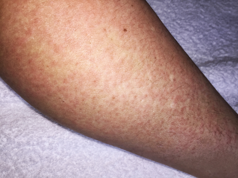 Cold Urticaria allergic on leg background