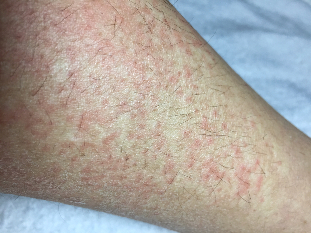 Cold Urticaria allergic on leg background