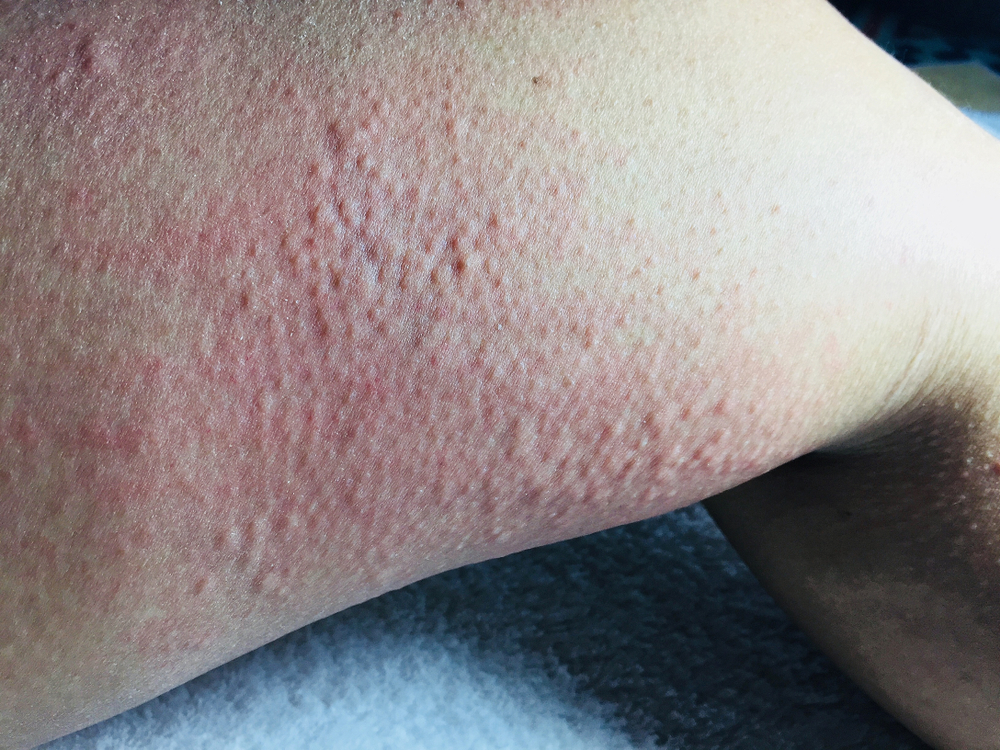 Cold Urticaria on leg background