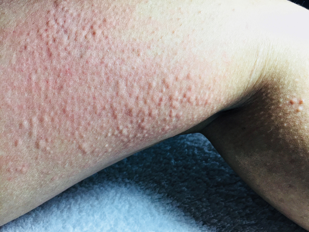Cold Urticaria allergic on leg background