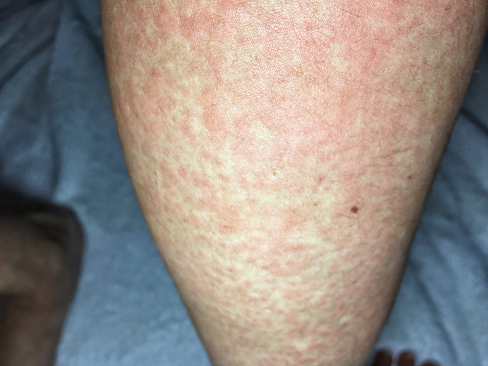 Cold Urticaria allergic on leg in winter