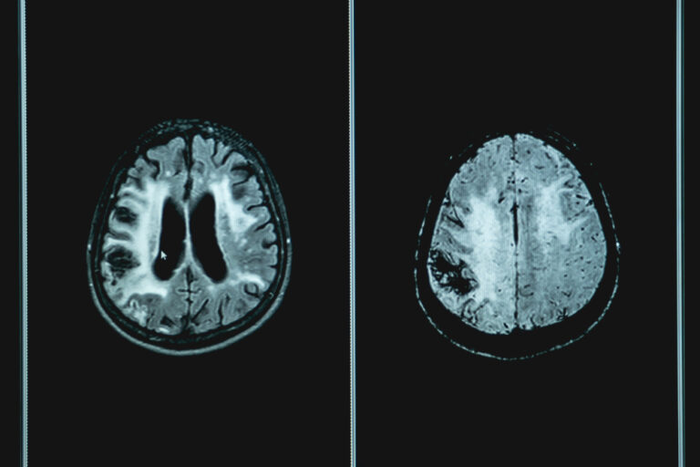 Woman Living With Dementia for 10 Years Tried One Fix That Changed Everything - Featured image