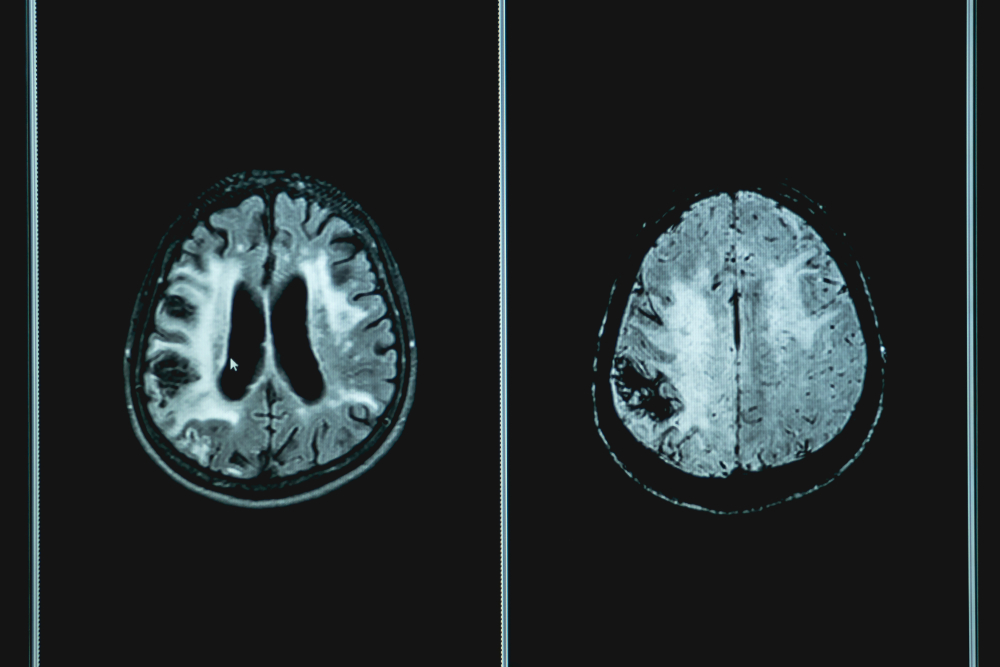 Woman Living With Dementia for 10 Years Tried One Fix That Changed Everything - Featured image