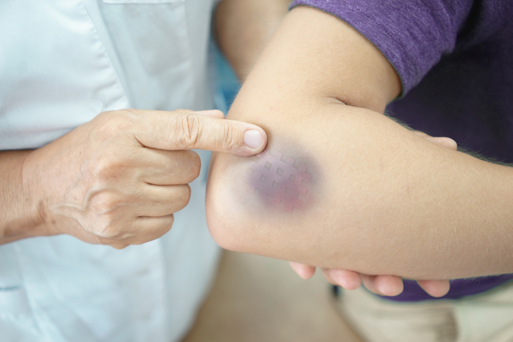 bruise on the patient's arm doctor's hand