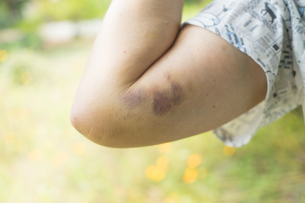 Close up Bruising on the old woman arm. Woman violence concept, contusion bruises on arm.