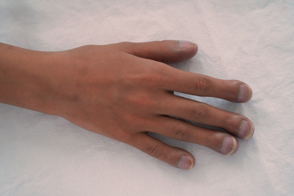 Right hand of patient with congenital cyanotic heart disease on white background. Typical characteristic for clubbing fingers. Focus on the fingers.