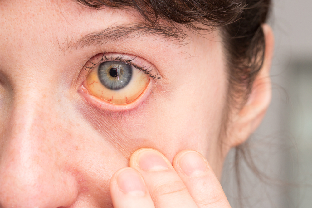 Close-up of girl's eye with yellow sclera caused by jaundice