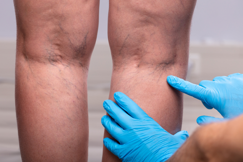 Medic With Blue Latex Surgical Gloves Touching Varicose Veins On Patient's Leg