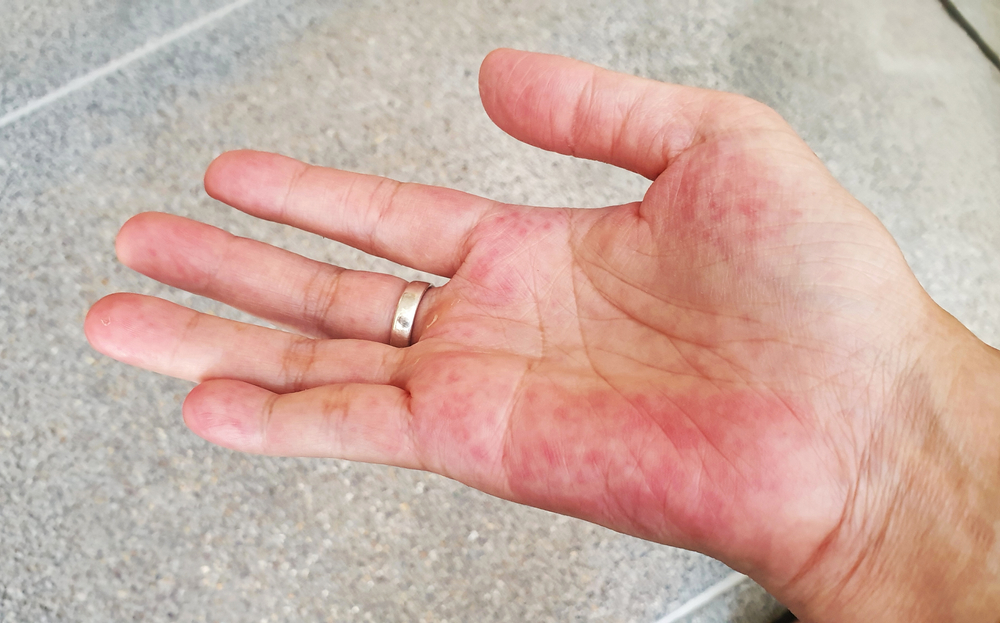 Unusual red on the palm hand from SLE symptom effect blood system. Systemic lupus erythematosus (SLE) is a chronic disease caused by self-immunity which causes effects on the organs and blood system.