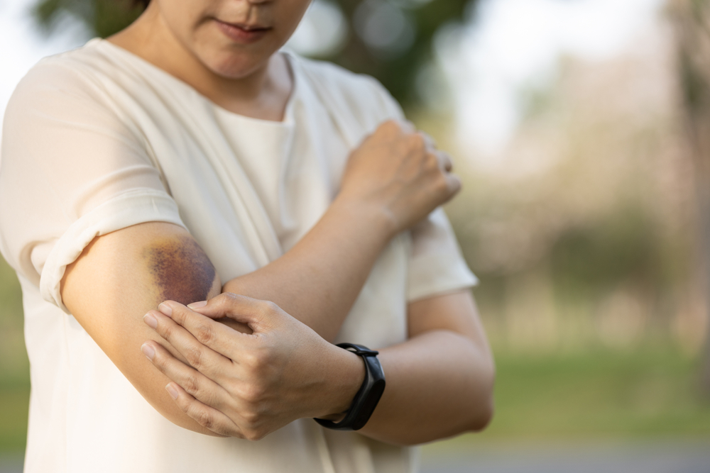 Sad asian female people showing a bruise in her arm,woman has bruises all over her body,caused by the abuse of a family or her husband violently attacked,being hit by a hard,bashing causes bruising