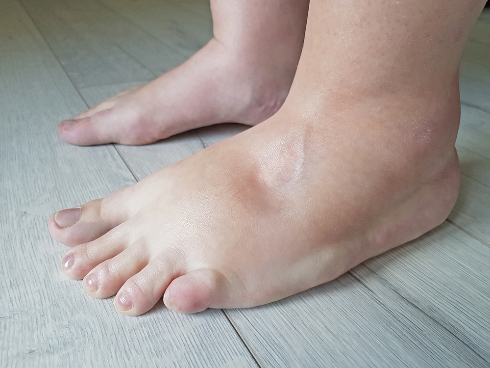 Swollen feets because water retention in the body