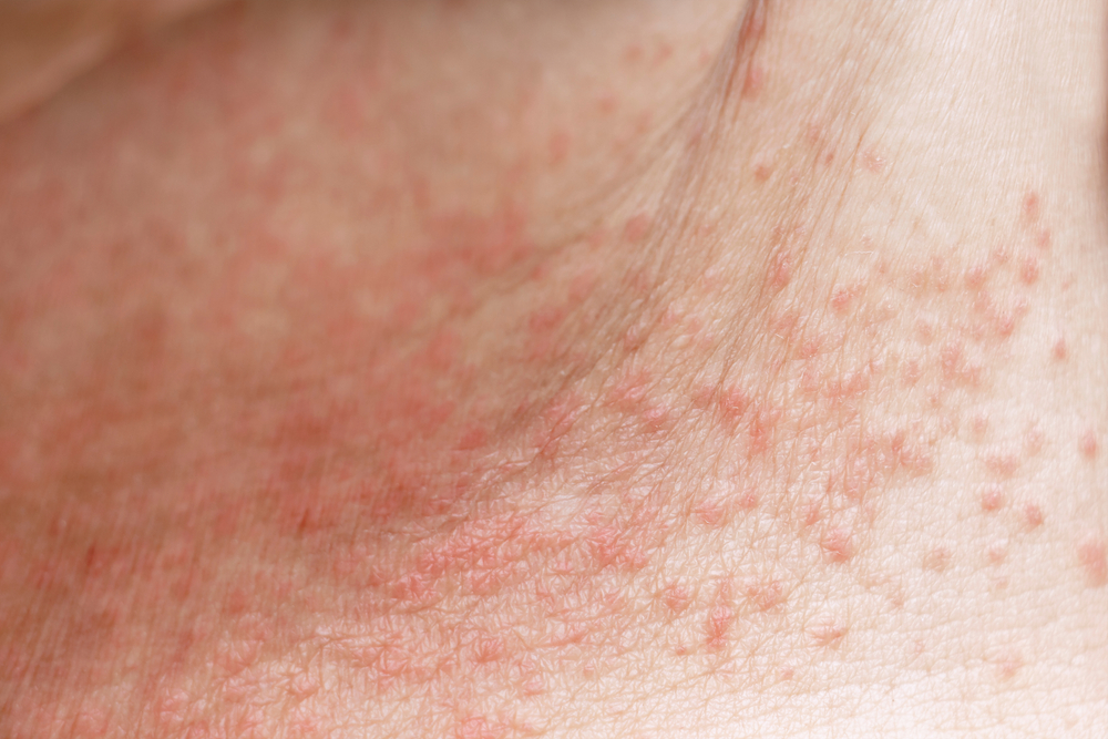 Skin disease prickly heat rash or miliaria on belly skin of woman. Healthcare skin cause for outdoor work in sunny with hot weather and have sweat. Dermatologist and treatment medication concept.