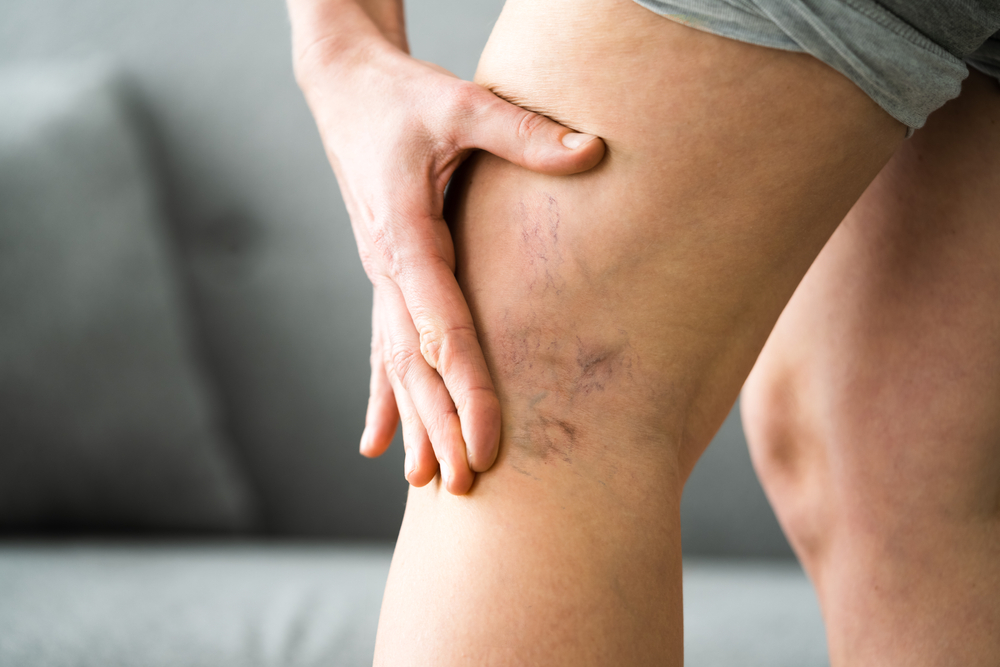 Before After Cellulite Inflammation Legs Treatment Closeup