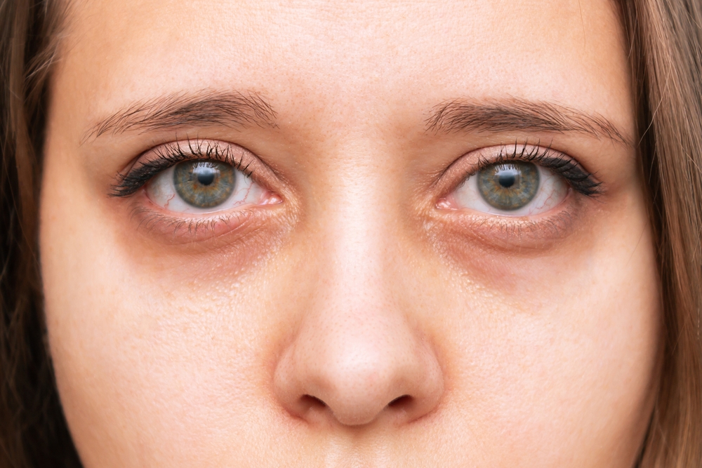 Cropped shot of a young woman's face. Green eyes with dark circles under eyes with red capillaries. Bruises under the eyes are caused by fatigue, nervousness, lack of sleep, insomnia and stress

