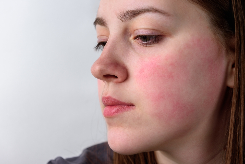Close up view on the cheek of a woman with red cheeks after the wind. Allergy concept.
