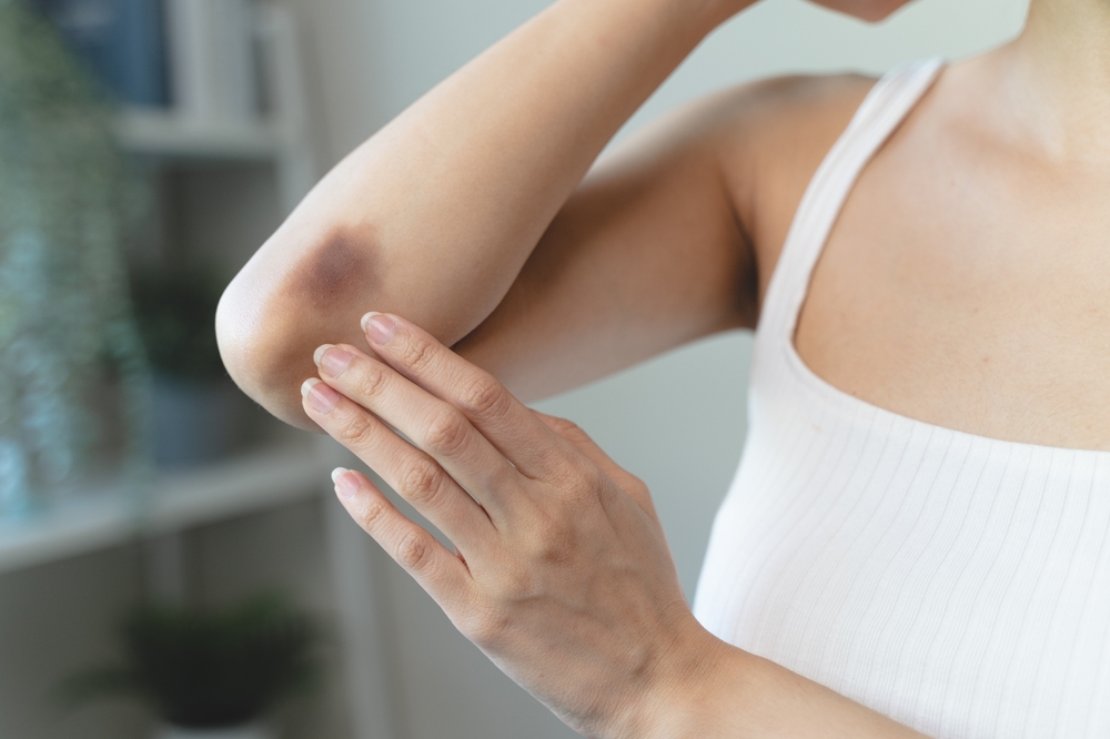 woman get injured and have bruised on her arm.