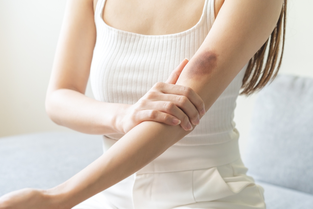 Close up of stain bruise wound on her arm, contusion asian young woman, girl an accident fell down stairs at home, hand in healing injury by massage hematoma blood. Extravasation blue, purple on skin.