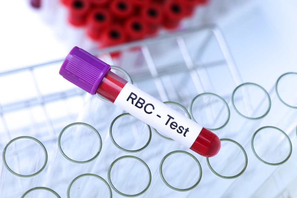 RBC test to look for abnormalities from blood, blood sample to analyze in the laboratory, blood in test tube