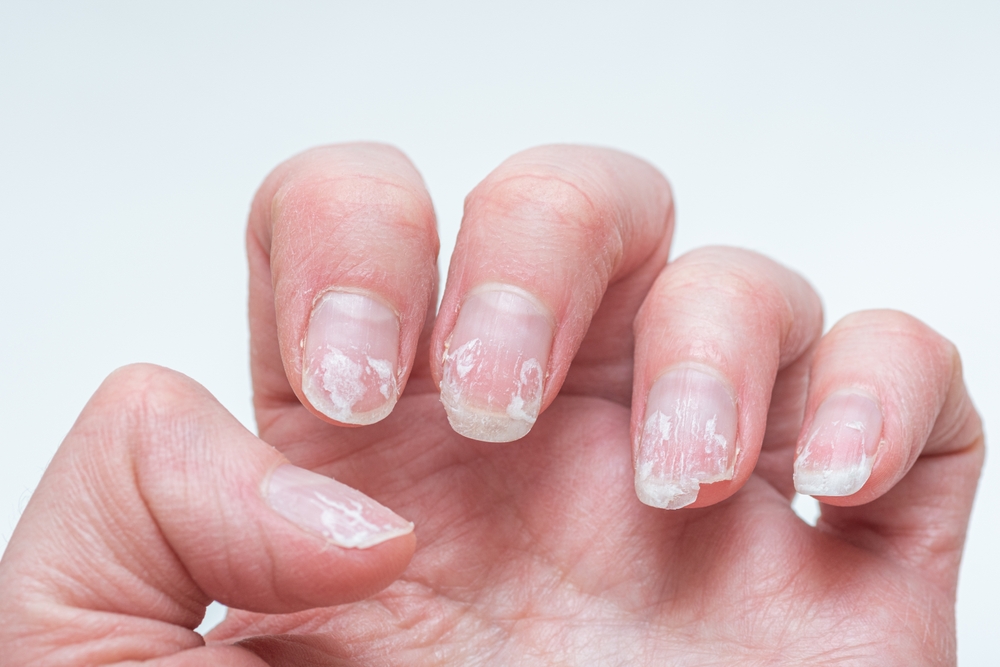 Flaky bitten and brittle nails without a manicure. Regrown nail cuticle and damaged nail plate after gel polish.
