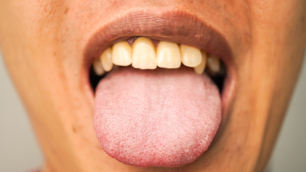 Close-up photo of a man sticking his tongue out, showing the detailed papillae on the tongue's surface. Concept for mouth and dental health
