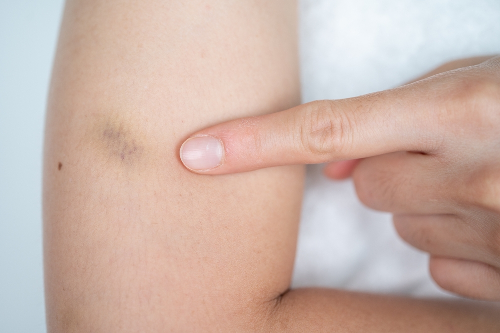 Cropped shot view of woman pointing to bruise occur on her skin. ruising can occur more easily as we age due to thinning of the skin