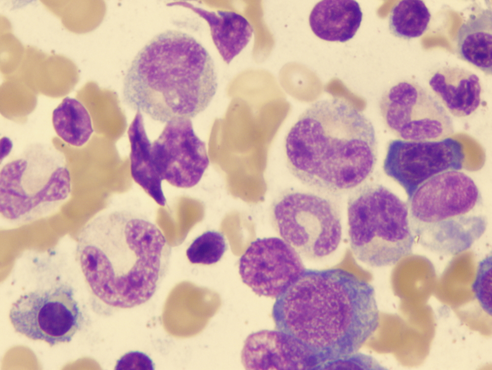 Pernicious anemia (giant band and myelocyte)