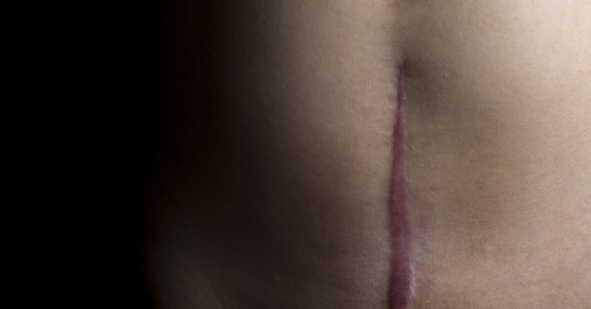 A Woman’s Unbelievable Act of Survival: She Performed Her Own C-Section