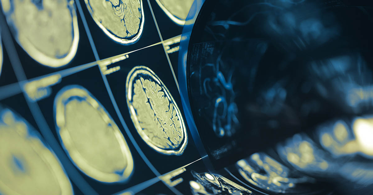14 Conditions That Drastically Change Your Brain
