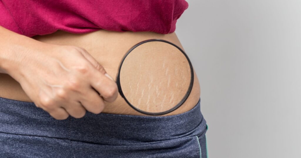 Women Show off the belly after birth. Stretch Marks on white background