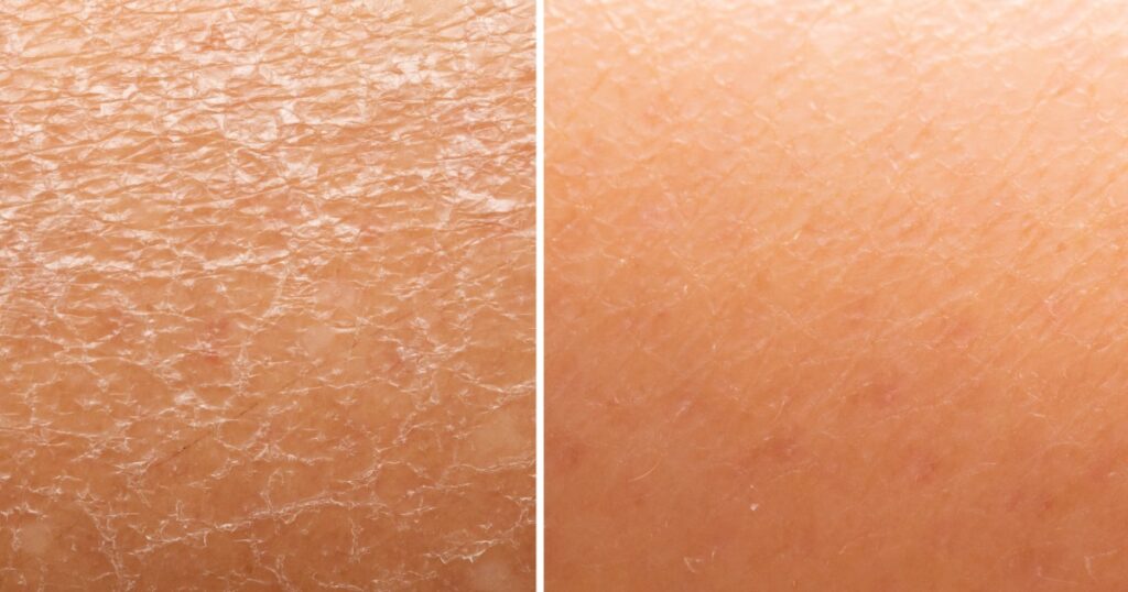 Before and after skin moisturization is seen in detail, with dried and cracked skin against a flawless smooth complexion.