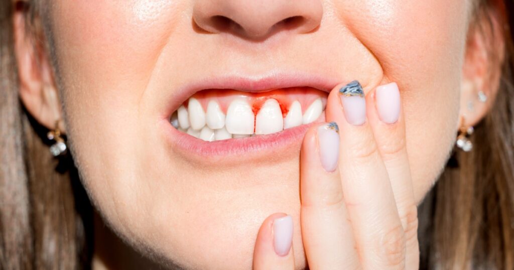 Woman filling pain because of bleeding gums. Periodontal disease, avitaminosis, gingivitis, scurvy