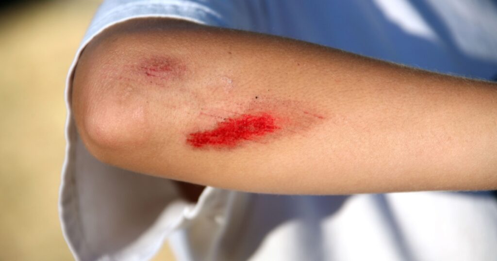 Young Child With Bloody Scrape on Arm