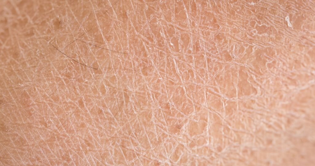 Macro dry skin (ichthyosis) detail