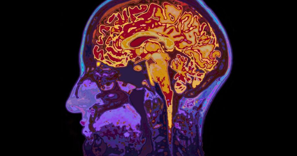 MRI Image Of Head Showing Brain