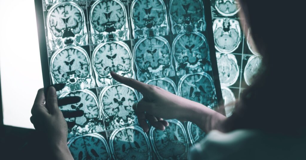 alzheimer's disease on MRI