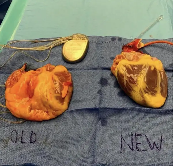 A Tale of Two Hearts: The Journey from Ailing to Healthy