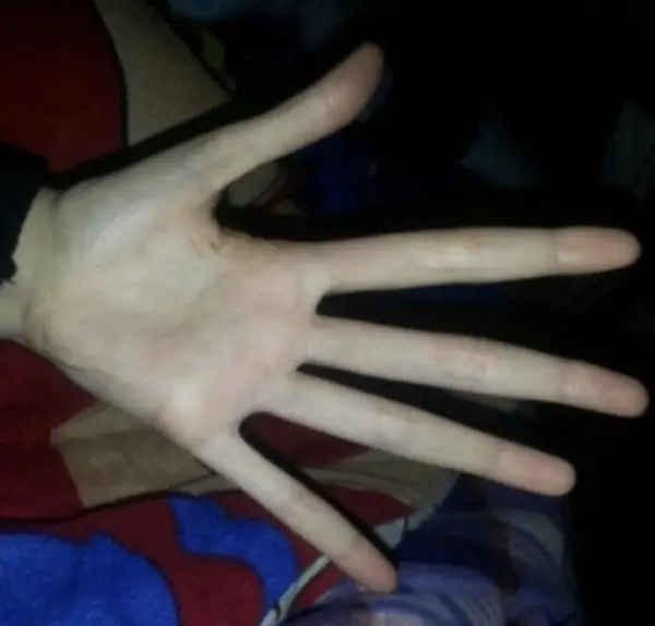 Embracing Marfan Syndrome: Extending Hands, Extending Understanding