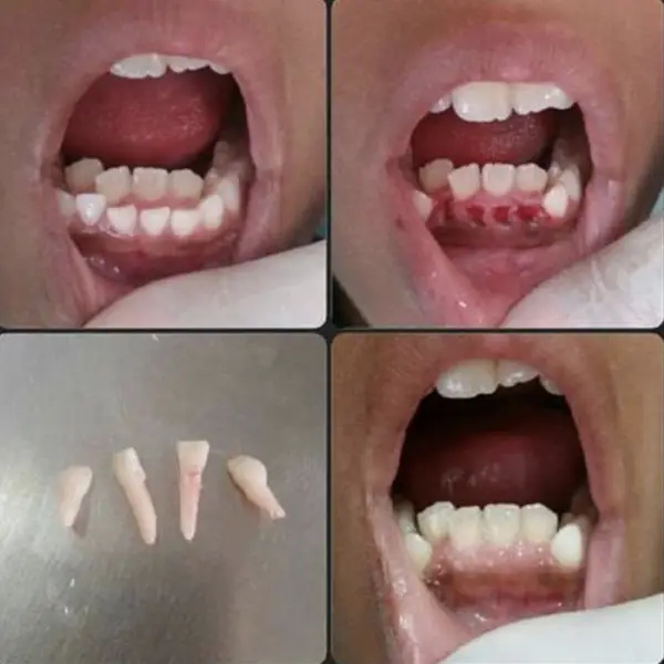 More Than Just a Smile: Further Revelations of Hyperdontia