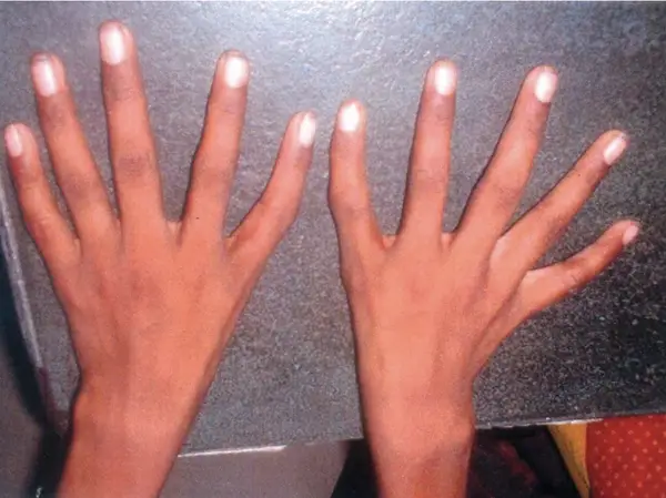 human body Triphalangeal Thumb Syndrome: A Unique Digital Perspective