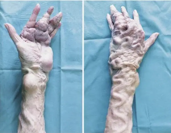 human body Parkes Weber Syndrome: Navigating Malformed Vasculature