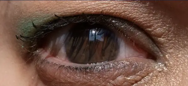 Unveiling the Unseen: Exploring the Eye without a Pupil
